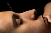 head acupuncture